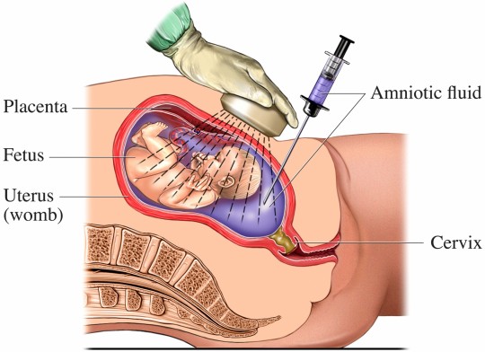 Amniocentesi 