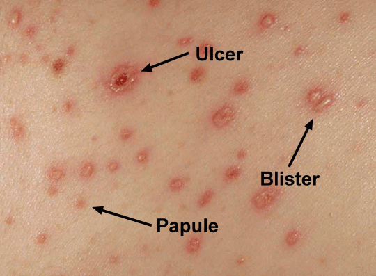 varicella 